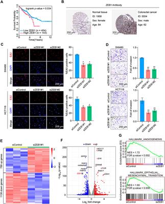 Transcription factor ZEB1 coordinating with NuRD complex to promote oncogenesis through glycolysis in colorectal cancer